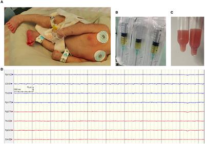 Case report: A rare multidrug-resistant Escherichia coli causes fatal neonatal meningoencephalitis